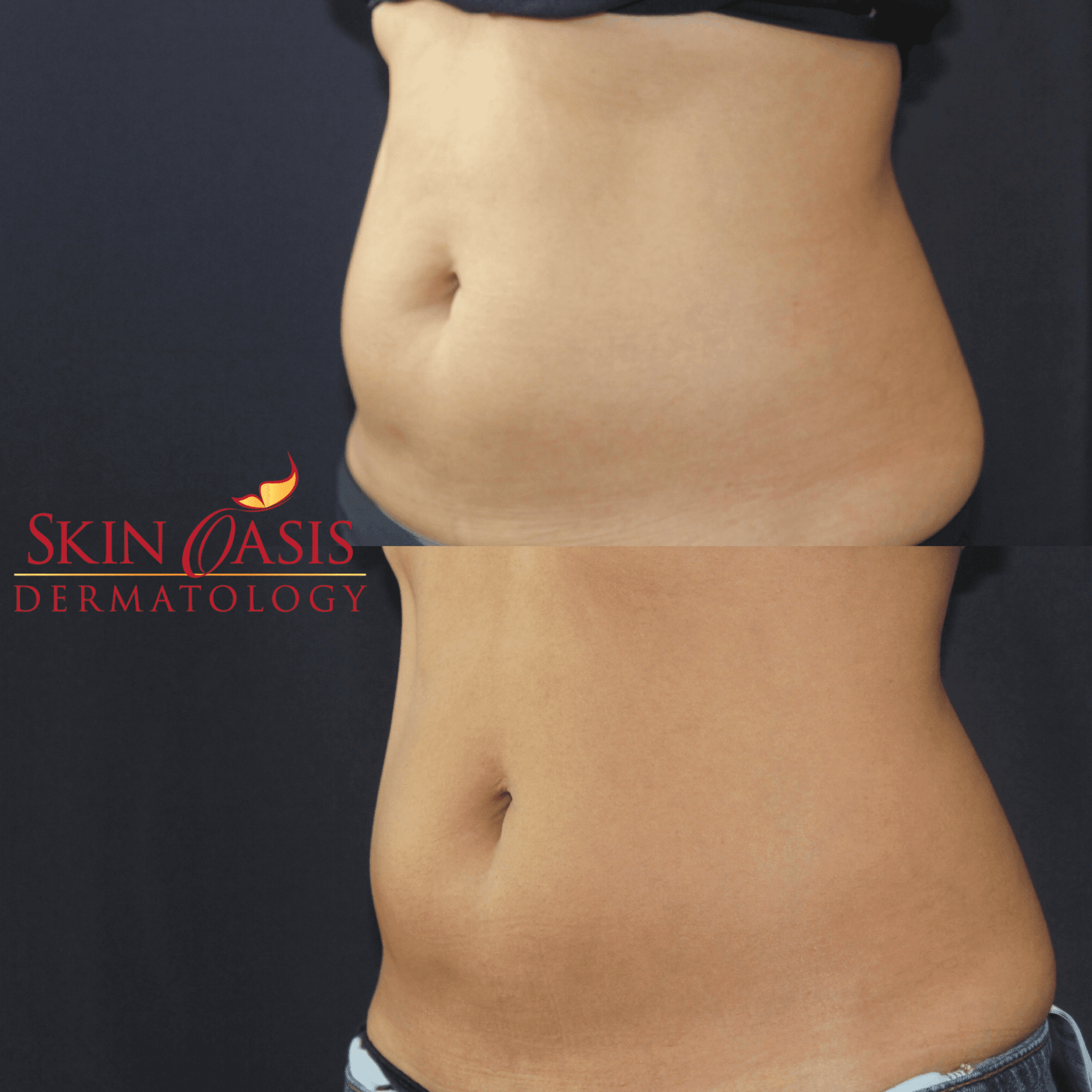 emsculpt, emsculpt results, emsculpt before and after, emsculpt treatments